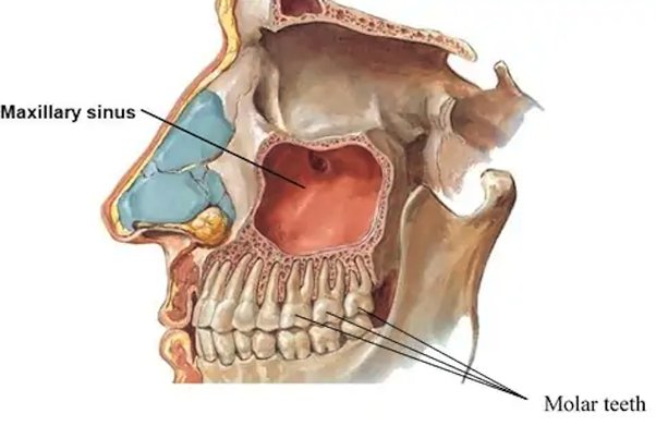 Qué tratar primero: los dientes o la sinusitis maxilar