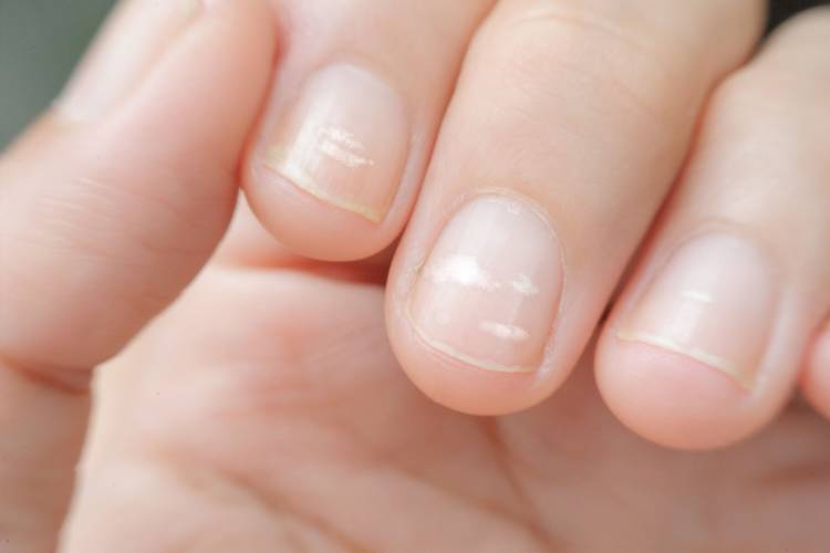 Manchas blancas en las uñas de las manos: causas