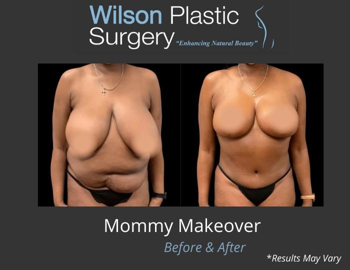 mommy-makeover-before-after-wilson-1-8755030-5425379