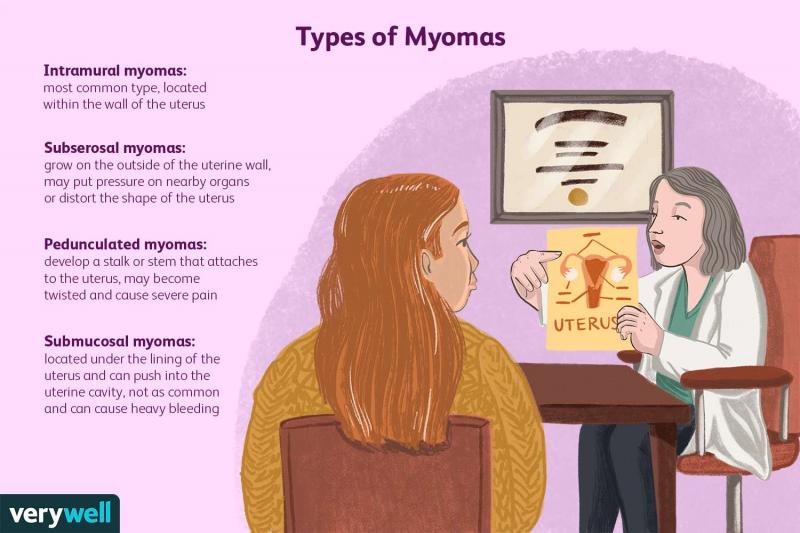 El mioma está causado por una alteración hormonal Mito 1