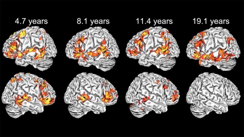 Test de los hemisferios cerebrales: cómo determinar cuál está más desarrollado y qué significa