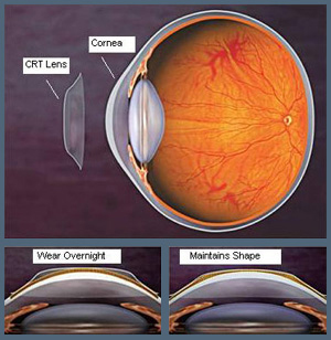 ¿Para quién están indicadas las lentes de ortoqueratología?