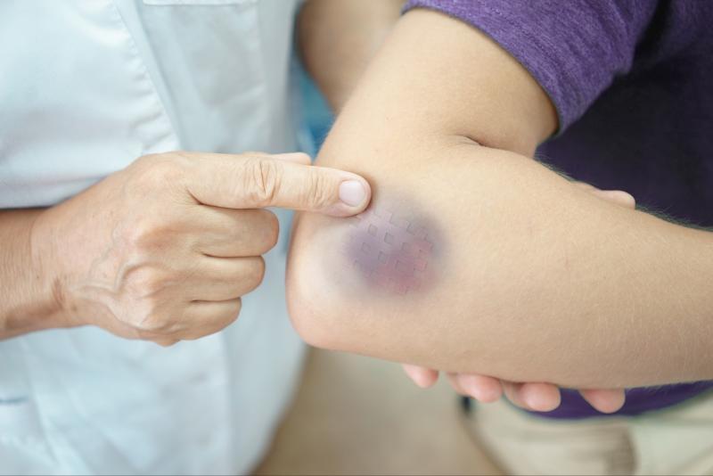 Síntomas de un hematoma