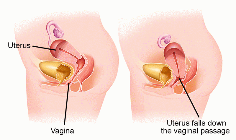 Tratamiento quirúrgico del prolapso de la pared vaginal