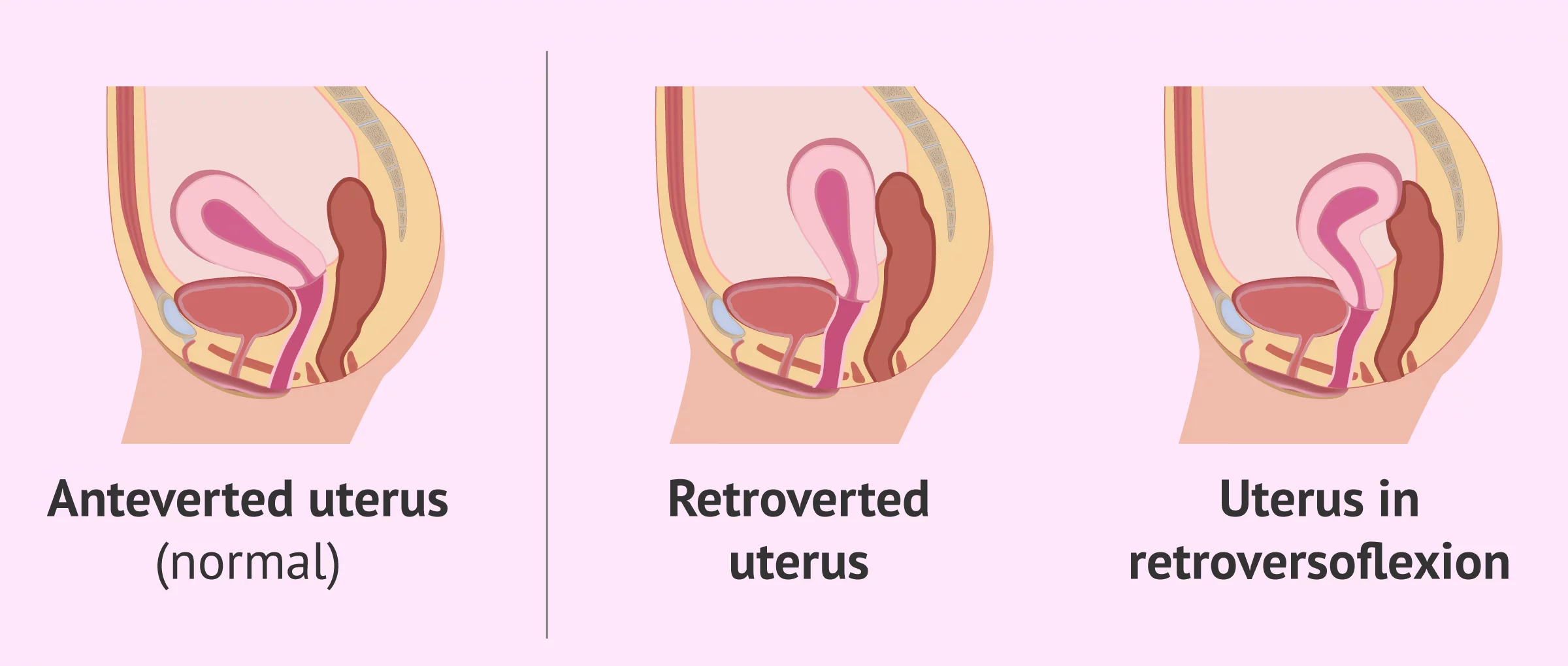 En posición incómoda: causas y consecuencias de la curvatura uterina