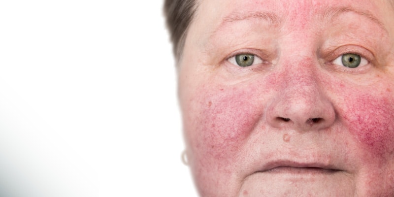 Cómo eliminar los asteriscos vasculares de la cara: hemos encontrado 8 formas que realmente funcionan