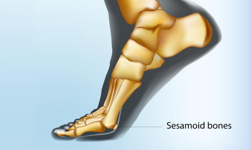 Huesecillo en el dedo gordo del pie: tratamiento y prevención