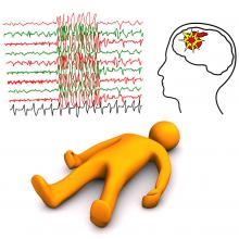 9 condiciones negativas que pueden desencadenar la epilepsia