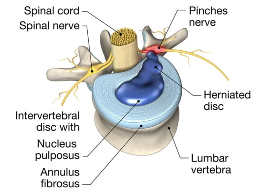 Protrusión discal espinal: qué es y cómo puede ser peligrosa