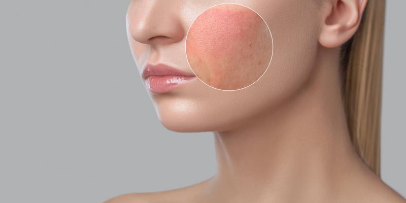 Opacidad e inflamación: por qué la piel del rostro se sobrecarga de cuidados y qué hacer al respecto