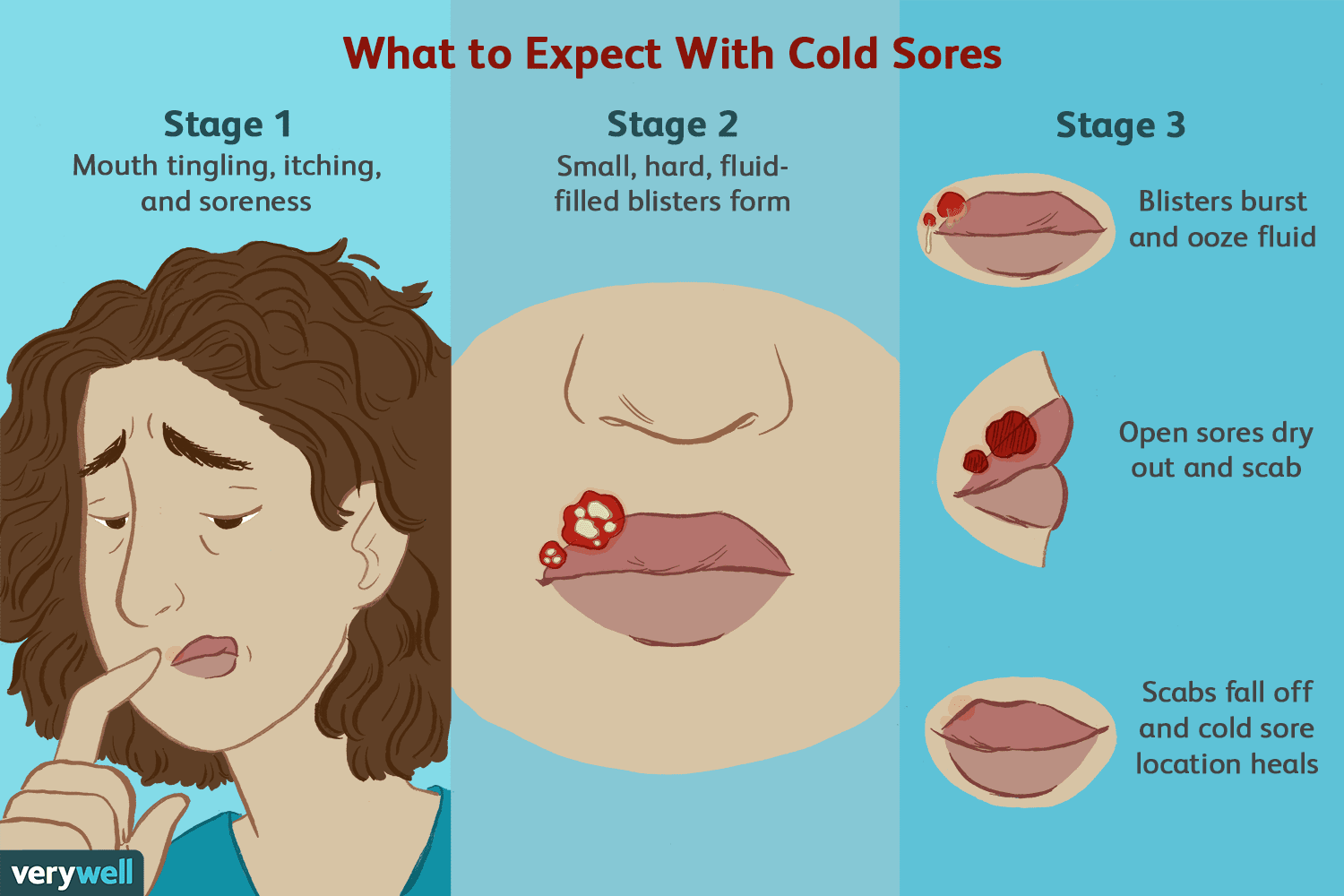 Hay una pregunta: ¿cómo curar rápidamente el herpes labial?