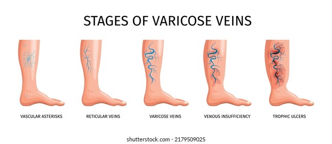 Asteriscos vasculares: un defecto estético o el primer signo de una enfermedad grave