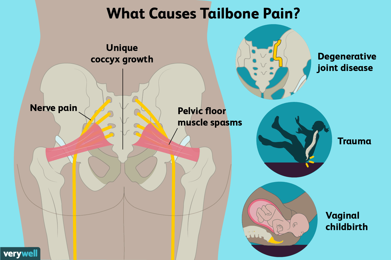 Dolor en el coxis: 10 causas principales, métodos de tratamiento y normas de prevención