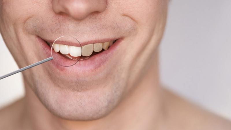 Quién no debe blanquearse los dientes: 6 indicadores clave