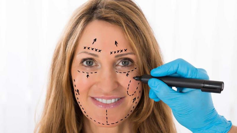Lifting facial con hilos tensores: pros y contras de un procedimiento de rejuvenecimiento rápido