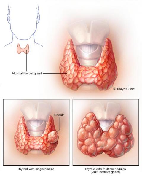 Nódulos en el tiroides: ¿qué son peligrosos y qué hacer?