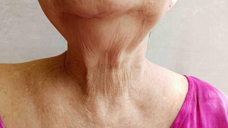 Causas del envejecimiento del cuello