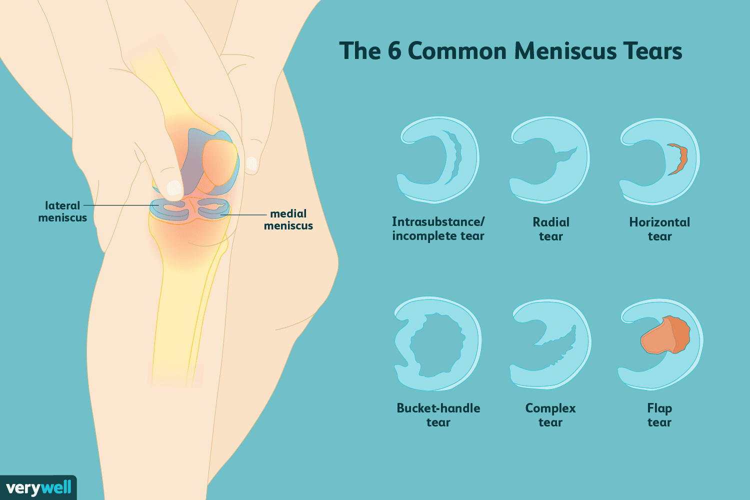 Lesión de menisco: cómo identificarla y tratarla