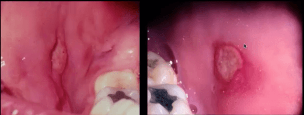 Estomatitis aftosa en niños: tratamiento de una enfermedad insidiosa