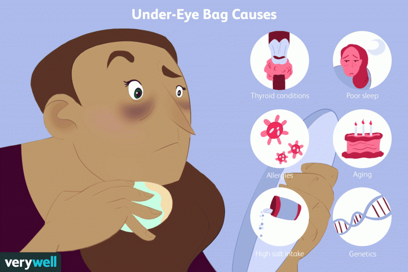 Bolsas bajo los ojos y problemas estomacales: cómo se relacionan - explica la nutricionista