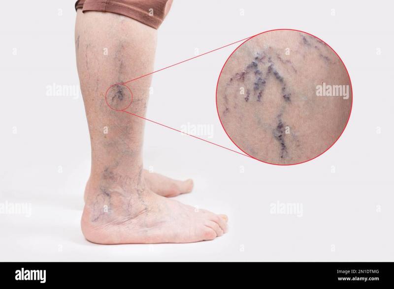Asteriscos vasculares en cara y piernas: 11 causas y 9 formas modernas de tratamiento