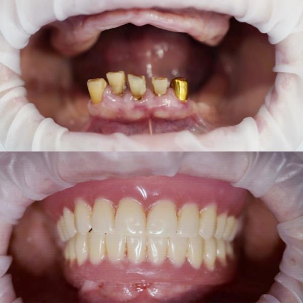 Una dentadura postiza extraíble no es la solución: ¿por qué?