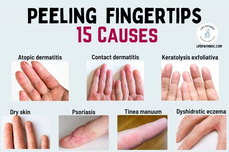 peeling-fingertips-7686217