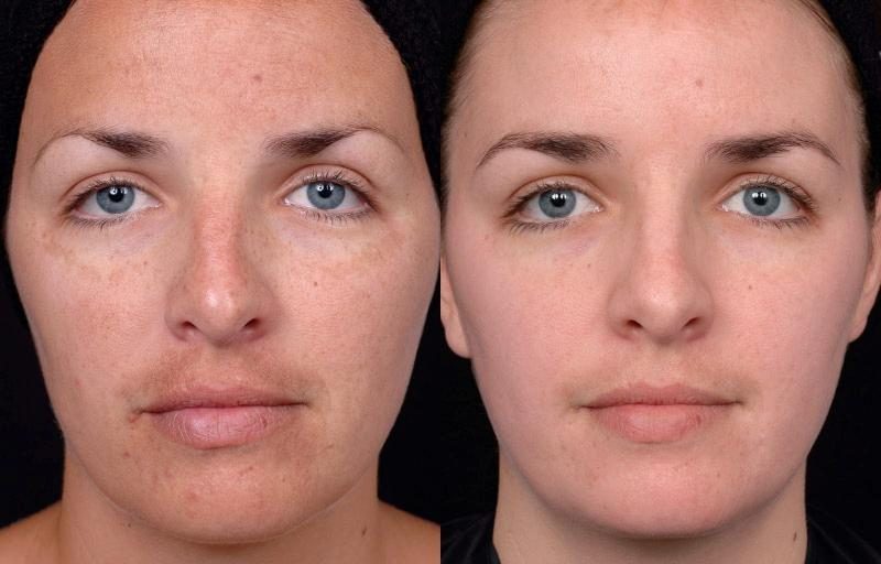 chemical-peel-2-5234442