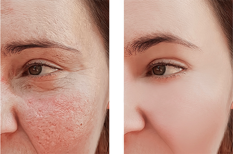 Resurfacing o peeling: qué es mejor y en qué casos