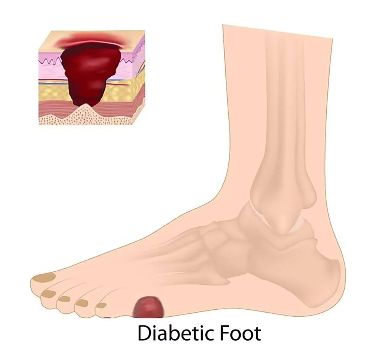 diabetic-peripheral-neuropathy_1200x1150-6800744