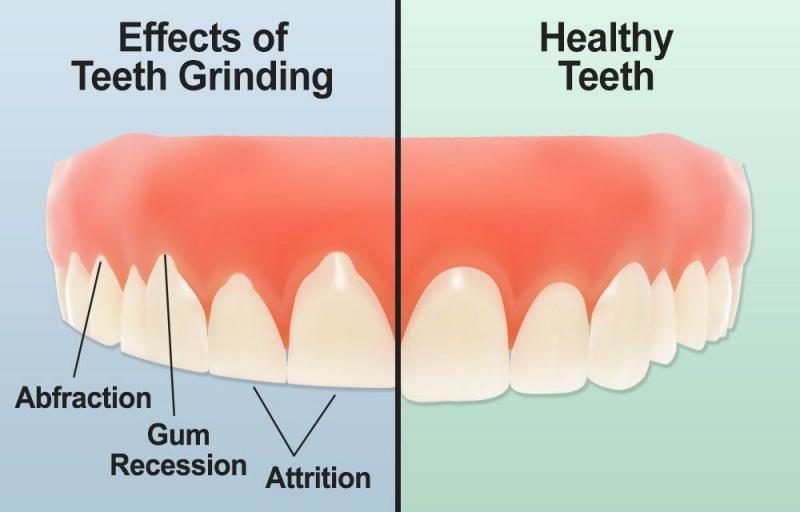 teeth_grinding-1000x640-1-5656890