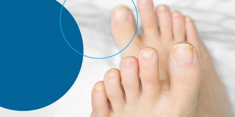 01-how-to-prevent-and-treat-toenail-fungus-1024x512-2052583