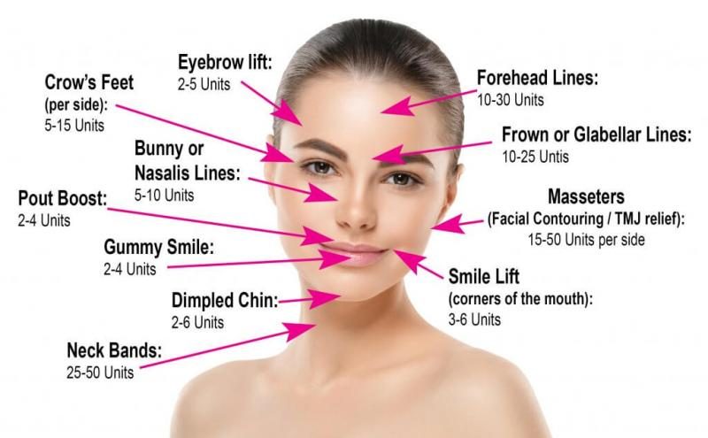 botox-facial-area-chart-7745836