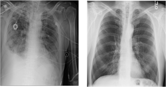 A capacidade dessa rede neural de analisar radiografias de tórax e diagnosticar com precisão doenças crônicas tem implicações significativas para o futuro da medicina. Ela não só pode ajudar os médicos a tomar decisões mais informadas, mas também tem o potencial de simplificar o processo de diagnóstico, economizando tempo e recursos valiosos. Além disso, poderia expandir o acesso ao atendimento médico em áreas remotas e comunidades carentes, onde os especialistas podem ser escassos.