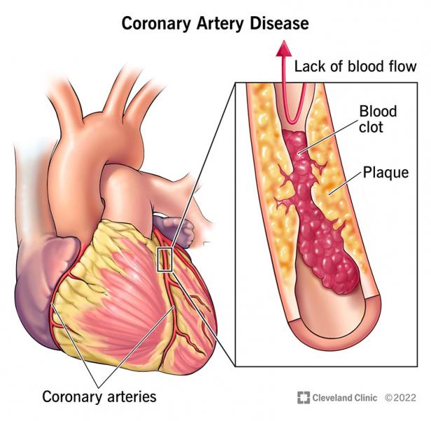 Angina