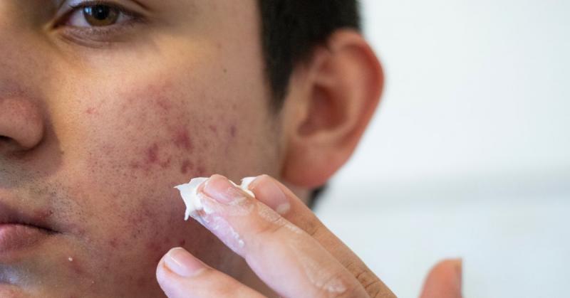 Como se livrar da acne facial da noite para o dia ou permanentemente? Guia completo