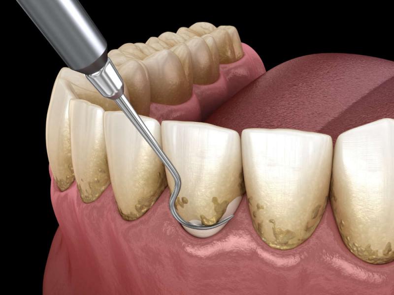 A condição importante é escovar os dentes corretamente