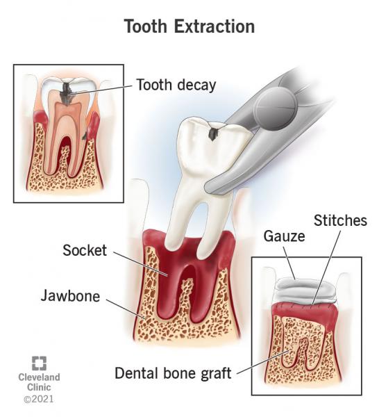 O que você pode e o que não pode fazer após a extração de um dente: 6 regras de um dentista