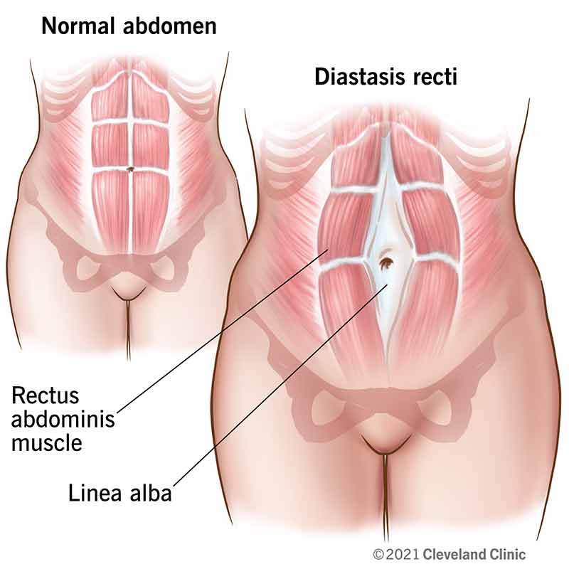 Como remover a diástase