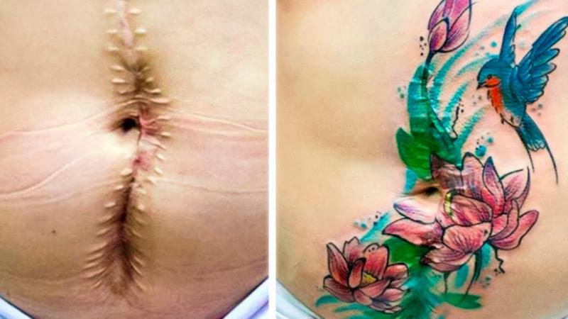 Cremes para remoção de tatuagens