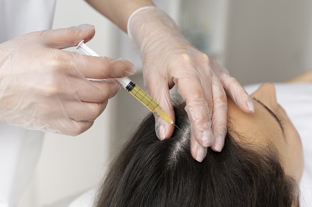 Mesoterapia para cabelos: tudo o que você queria saber sobre esse procedimento