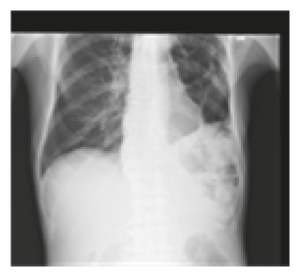 Um dos exemplos mais promissores dessa tecnologia inovadora é uma rede neural desenvolvida por uma equipe de pesquisadores. Essa rede neural foi treinada em um enorme conjunto de dados de radiografias de tórax de pacientes com várias doenças crônicas, incluindo câncer de pulmão, doenças cardíacas e pneumonia. Ao analisar essas imagens, a rede neural aprendeu a reconhecer padrões e anormalidades associados a diferentes doenças.