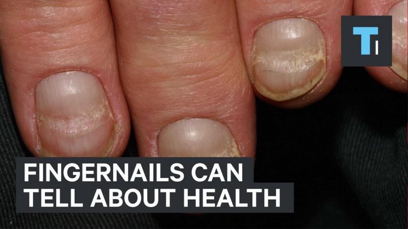 Nenhuma manicure pode esconder: Quais problemas de saúde suas unhas podem indicar