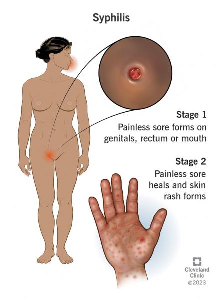 4 novas e perigosas infecções sexualmente transmissíveis das quais você talvez não tenha ouvido falar