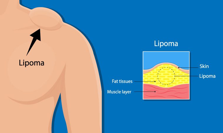 Sem lipomas: como se livrar de lesões gordurosas no rosto?