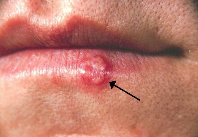 Herpes labial: quem está em risco e como curar rapidamente e sem complicações
