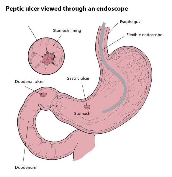 Como tratar a úlcera péptica