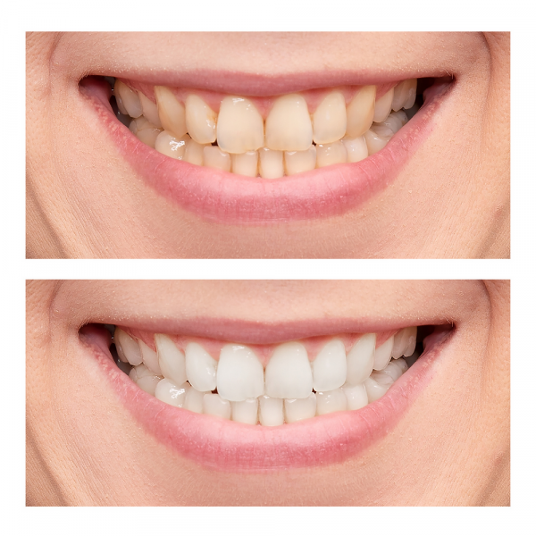 Dentes amarelos: quais são as causas desse problema (e como recuperar um sorriso mais branco)