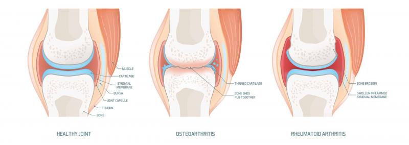 Artrite e osteoartrite: como reconhecer e ajudar a si mesmo (e quando é hora de consultar um médico)