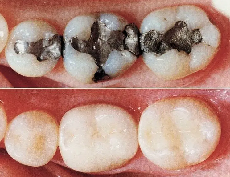 2. Restaurar a funcionalidade do dente: